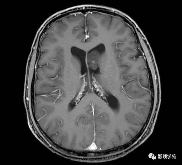 侧脑室肿瘤图片