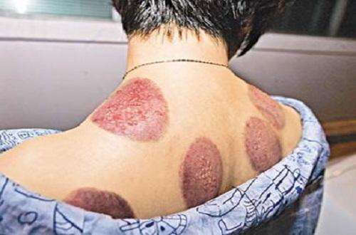 拔罐前可以涂身体乳么(拔罐前可以涂身体乳么吗)