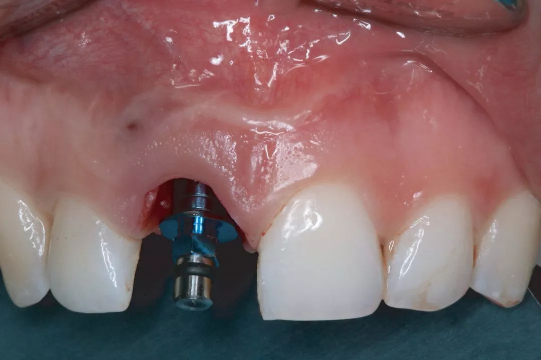 上颌中切牙即刻种植一例