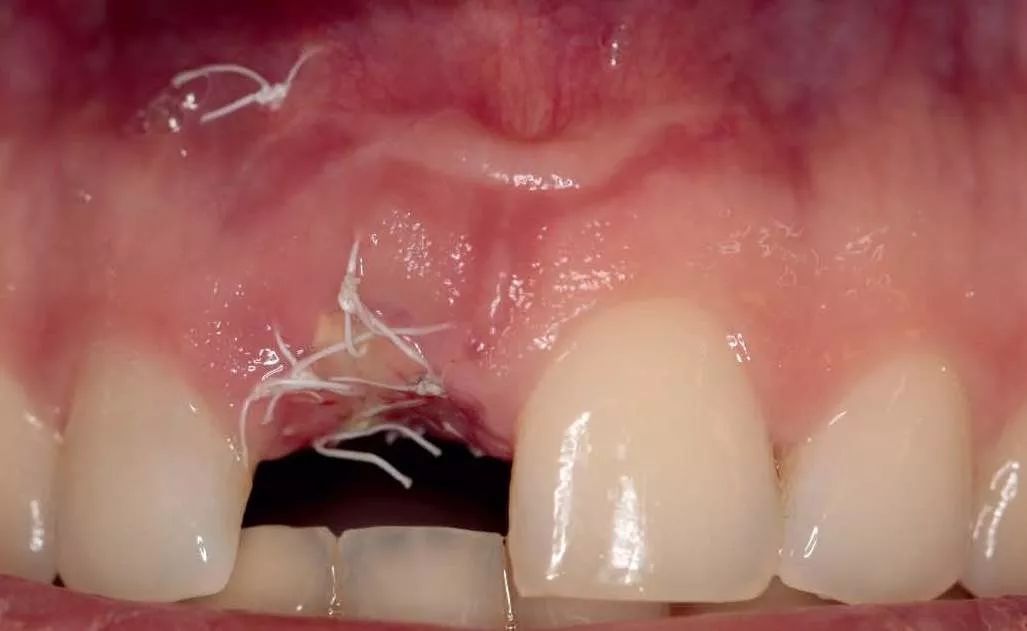 中切牙雕牙的过程图片图片