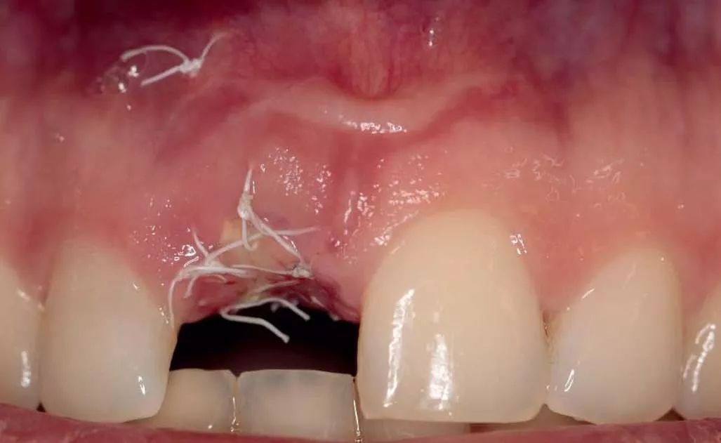 上颌中切牙即刻种植一例