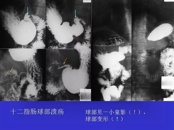 胃十二指肠溃疡镜下图片