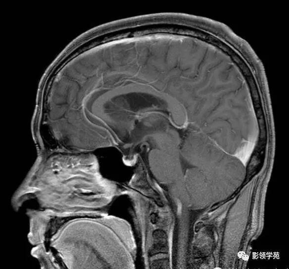 侧脑室内见类圆形稍长t1中等t2信号肿块室管膜下瘤