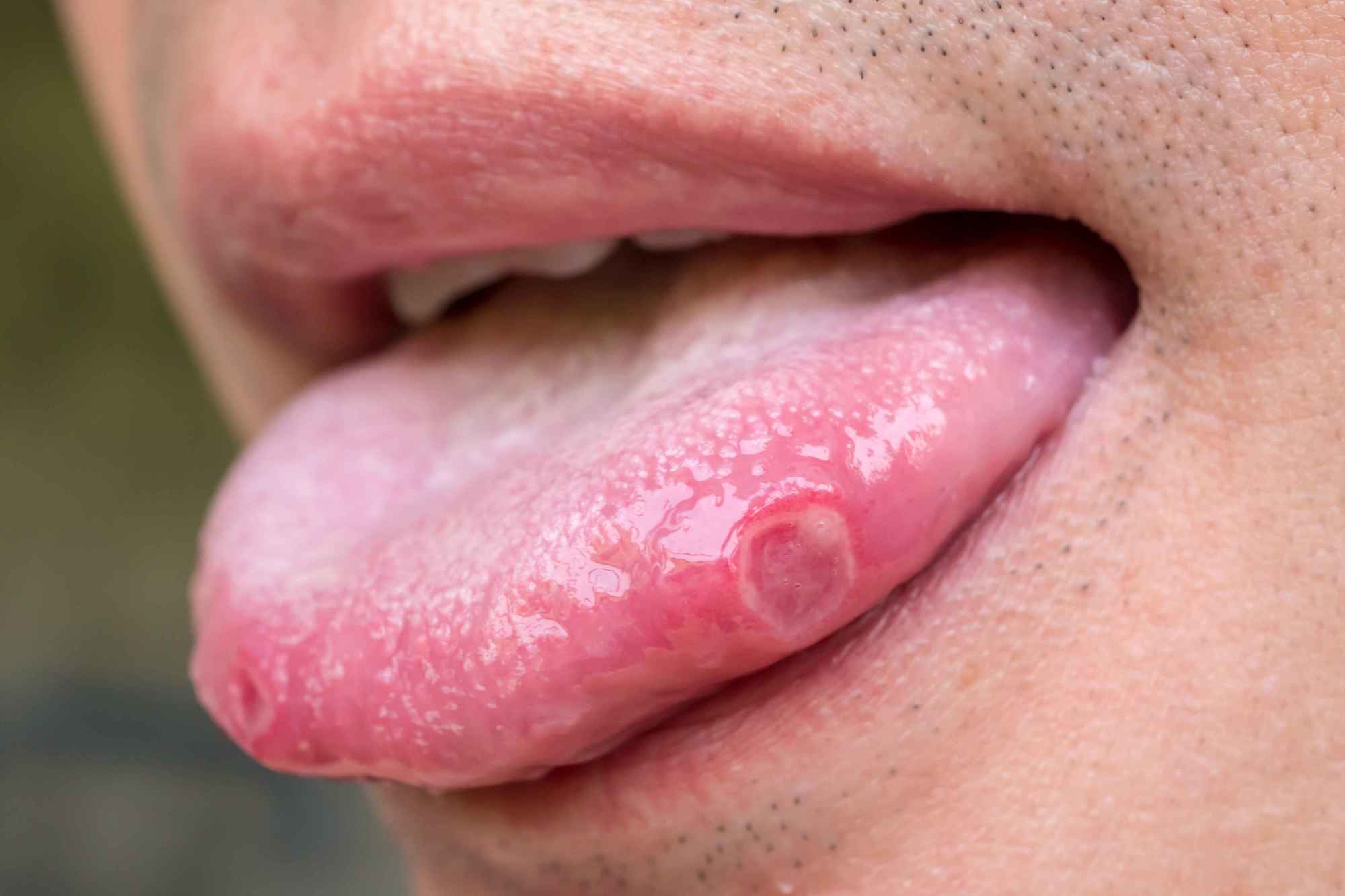 舌内有癌 嘴巴先知 若口腔有这4个表现 暗示舌癌已到中晚期 舌头
