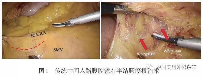 中间入路腹腔镜右半结肠癌根治术临床对比研究(本文配发视频)_手术