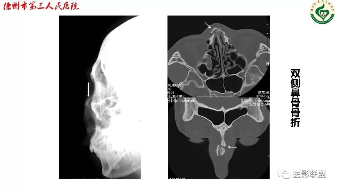 清晰图讲解:鼻骨骨折影像学诊断