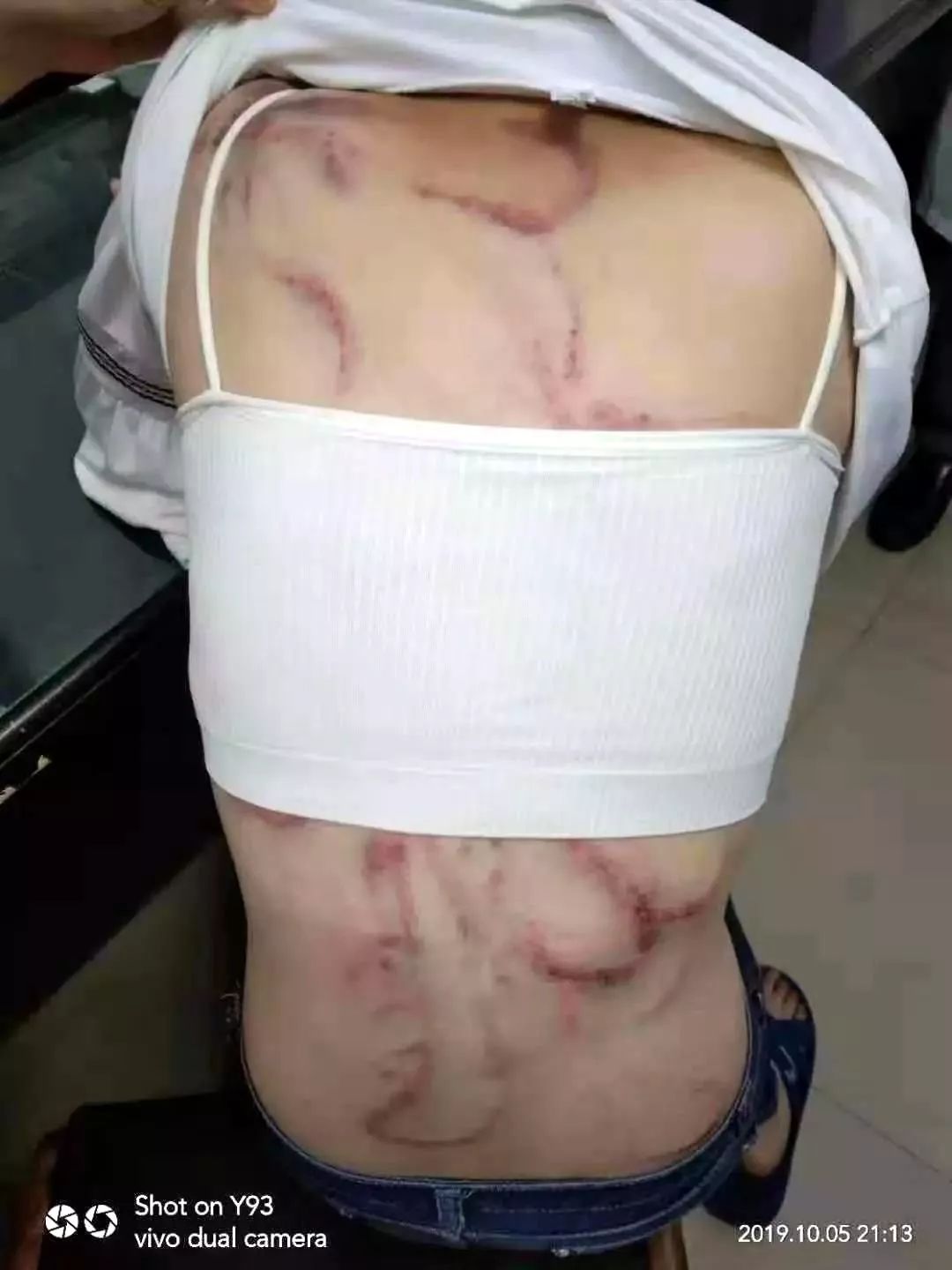 宜宾16岁女孩被父亲用皮带抽,衣架铲,全身伤痕累累,好惨啊!