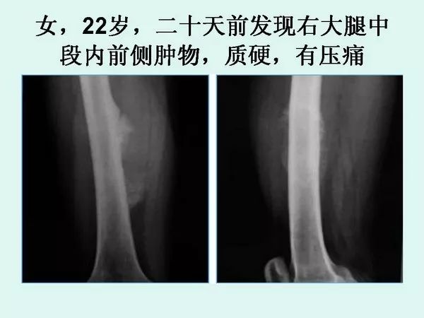 骨肉瘤DR图片图片