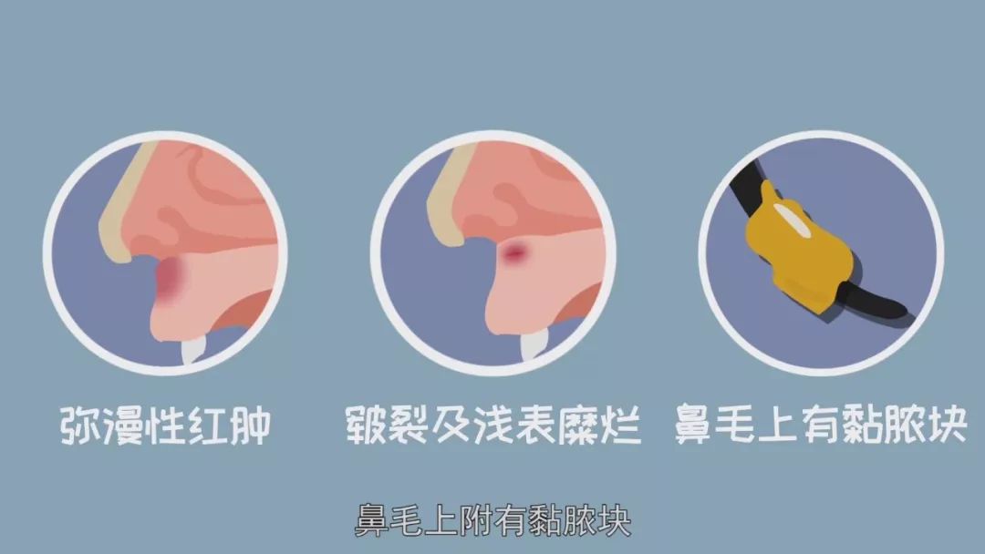 那个抠鼻屎可能会得的病 鼻前庭炎到底是啥 鼻腔
