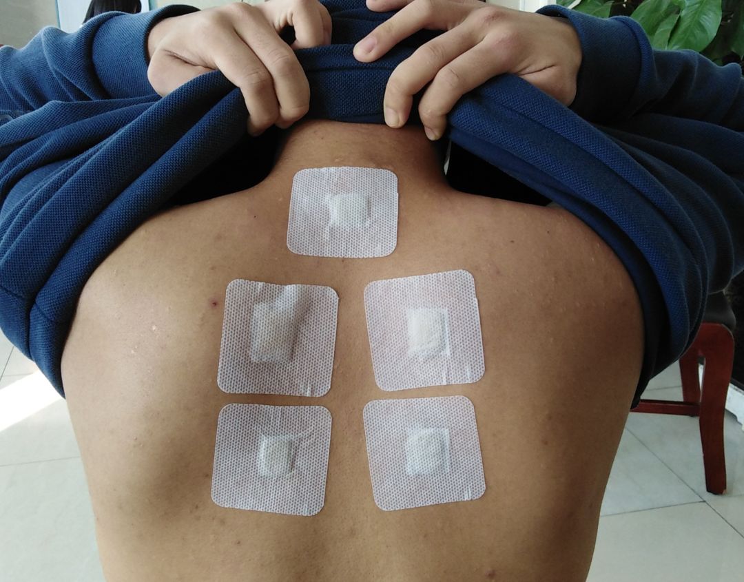 三九天将至二医院东院区康复一科三九贴服务开始啦