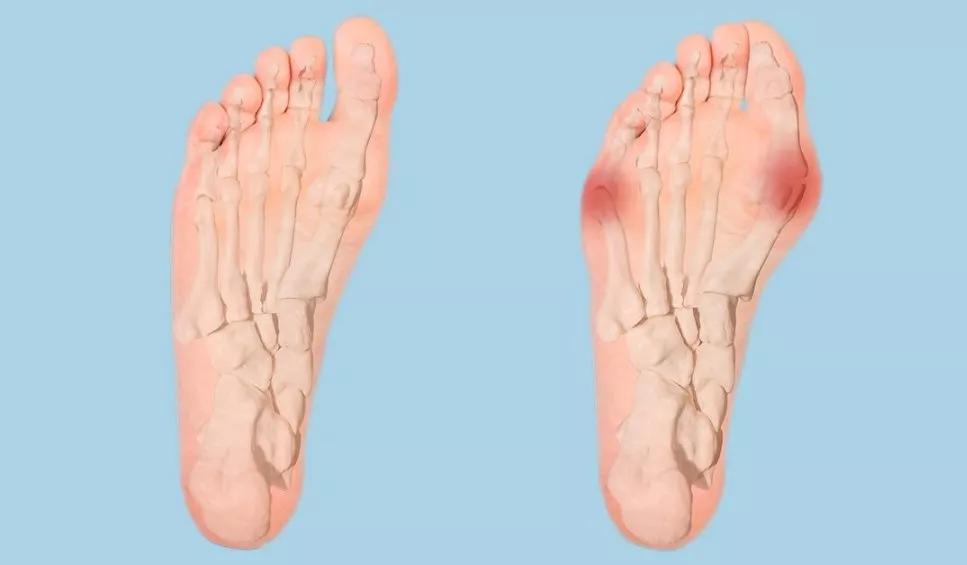 女性常见脚部畸形拇指外翻