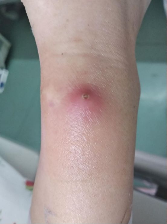 留置针拔除后针眼感染化脓罪魁祸首竟然是这个
