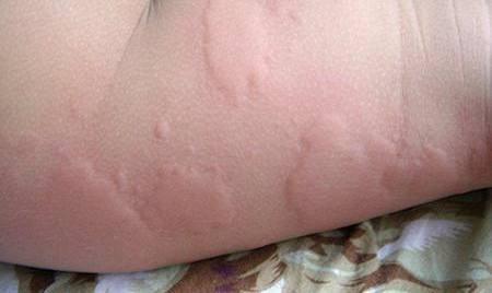 可以说不痒不痛还可以在皮肤上画画这是划痕性荨麻疹得治