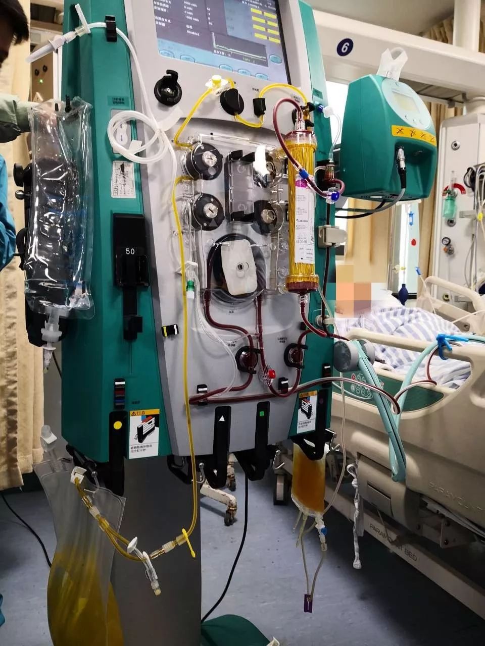 长兴完成首例人工肝治疗,这是一条"活路"!