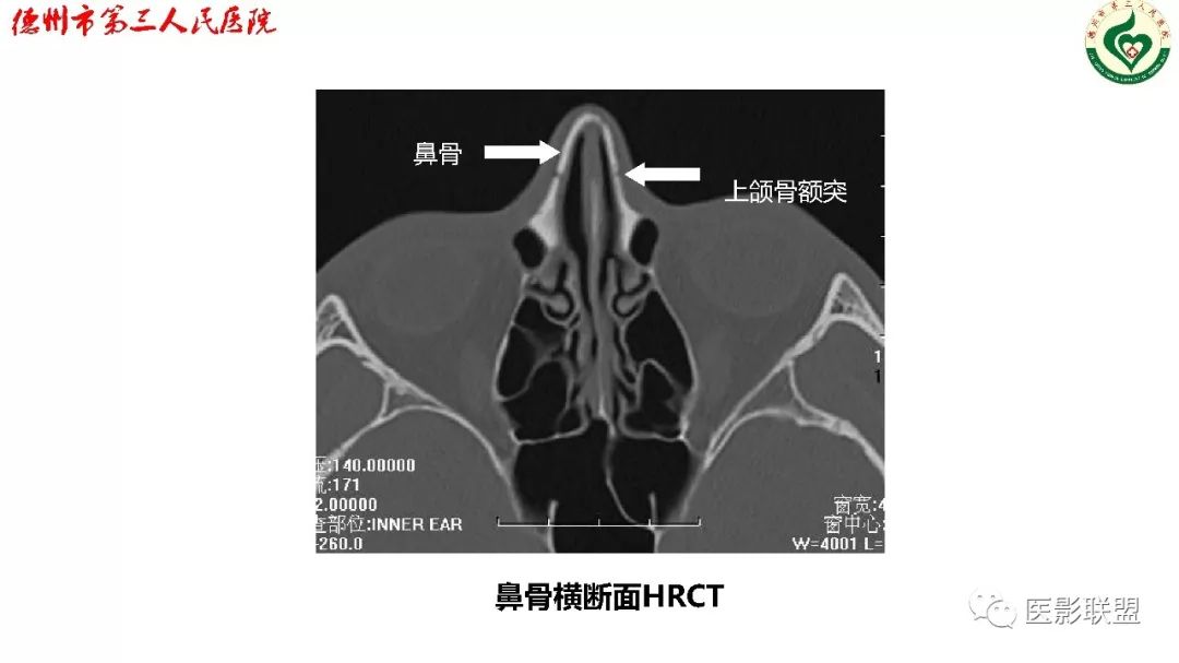 清晰图讲解:鼻骨骨折影像学诊断