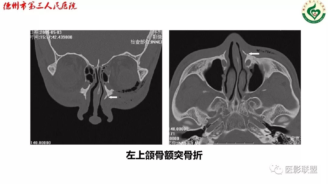 鼻骨骨折图片 x线图片