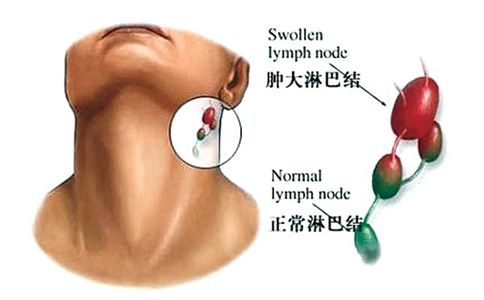 淋巴是人体重要的防御系统,它能保护我们的身体免受病毒的侵害,提高