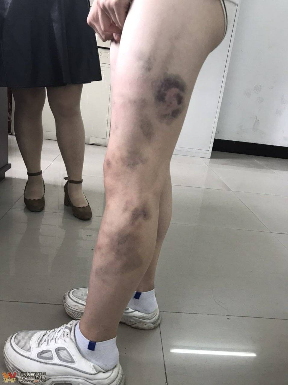 许用皮带和衣架毒打所致,毛某某和李某在孩子李某某被打伤前几个月已