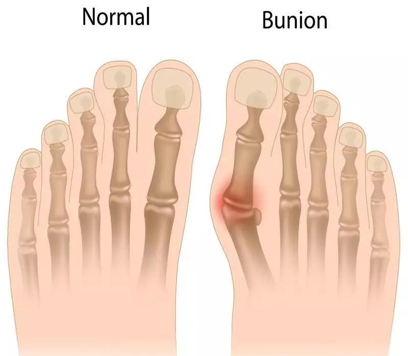 女性常见脚部畸形:拇指外翻!