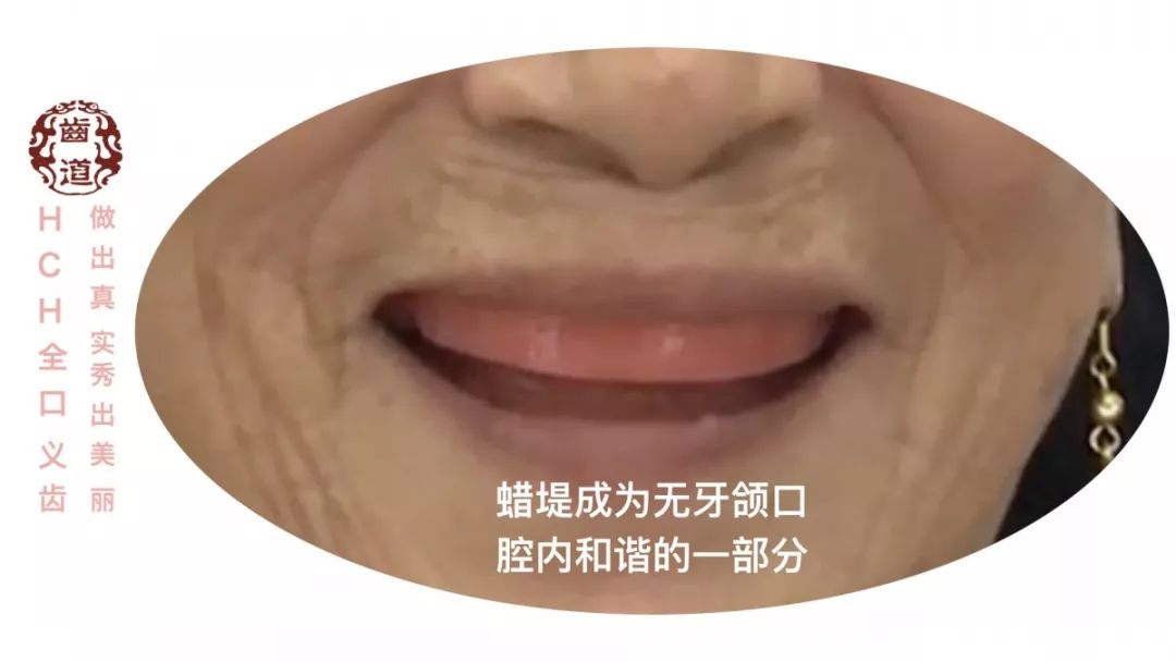 位关系,牙列与美学一体的临床解决方案 hch全口义齿功能蜡堤"