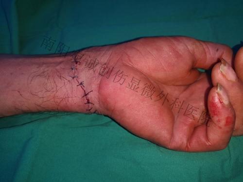 71岁老人锯柴取暖弄断手,医生提醒天冷劳动需当心_电锯