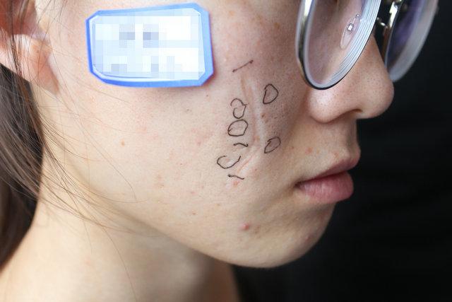 胥肖琴医生科普:凹陷疤痕的形成原因有哪些?