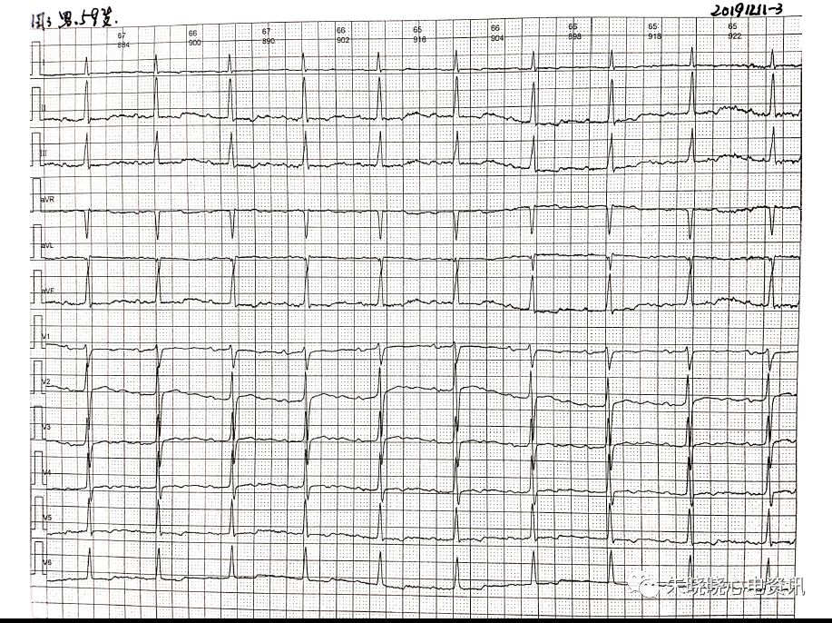 卢老师看心电图-- 房性早搏二联律伴干扰性pr间期延长及未下传心室