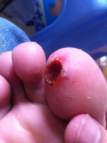 母瘊子会传染公的就不会吗那怎样区分呢