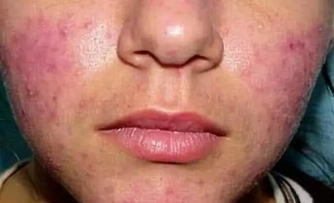 她的脸存在重度炎症,很可能是面霜中含有激素,造成了颜面再发性皮炎
