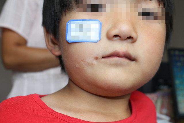 胥肖琴医生科普:凹陷疤痕的形成原因有哪些?