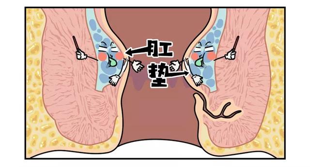 "有痔青年"是怎样炼成的:痔疮是如何出现的?又该如何预防治疗_肛门