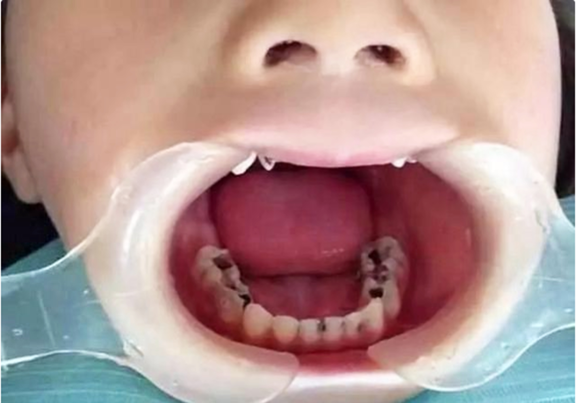 婴幼儿牙齿奶龋齿图片图片