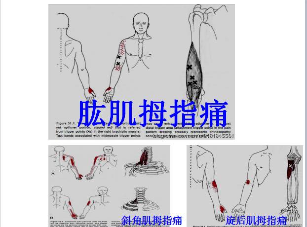 肱桡肌疼痛是什么原因图片