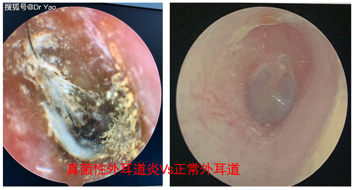 耳道真菌病感染图片