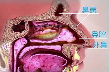 如鼻中隔偏曲,中鼻甲肥大,鼻息肉,变态反应性鼻炎,鼻腔异物或鼻腔肿瘤