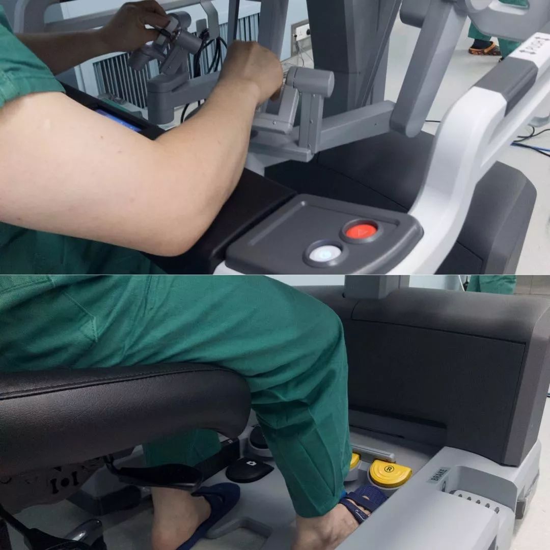 医生先在徐女士腹部打了4个小孔,"达芬奇"的4只机械臂通过穿刺通道