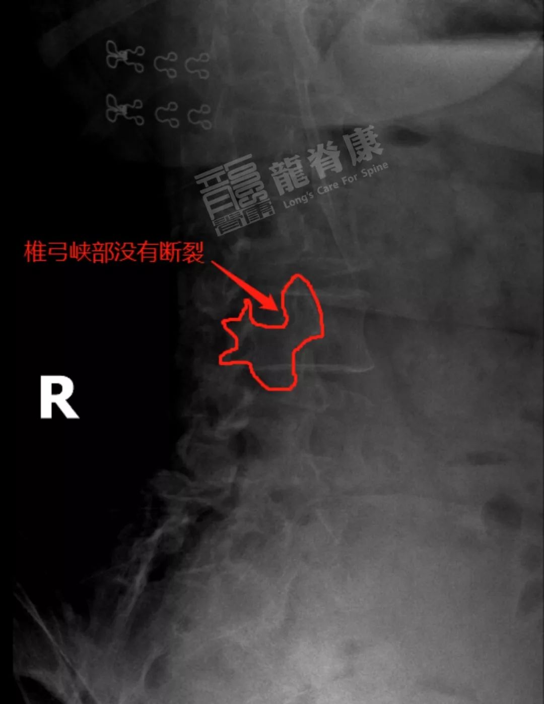 l4/5,l5/s1椎間隙明顯變窄,腰椎多棘突偏歪.