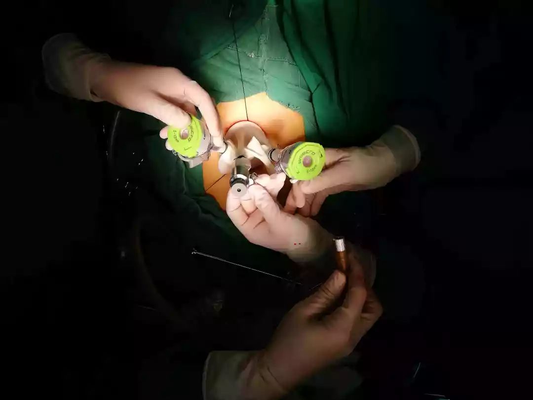 镜,利用自然的孔道进行的腹腔内镜手术,术后期腹部切口隐匿于脐孔窝内