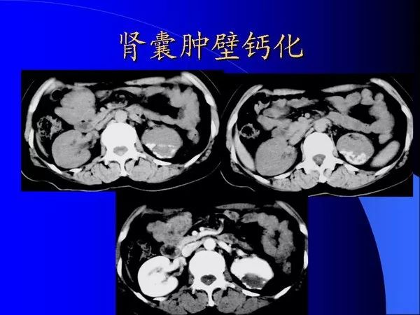 腎囊性病變的影像學表現