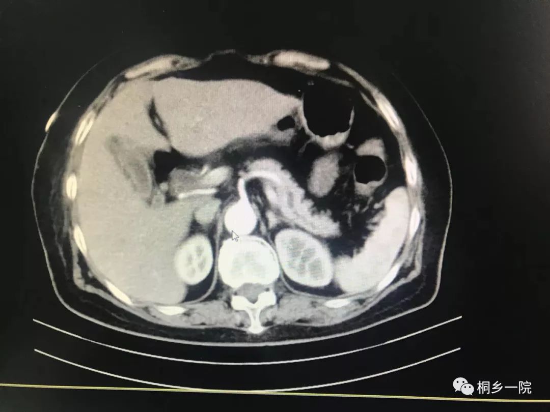 胰腺輕度萎縮,十二指腸壺腹部結節凸起,壺腹部腫瘤待排