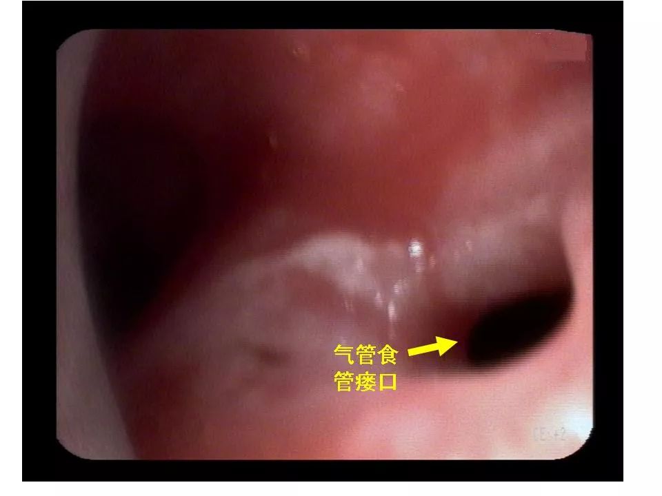 气管食管瘘图片图片