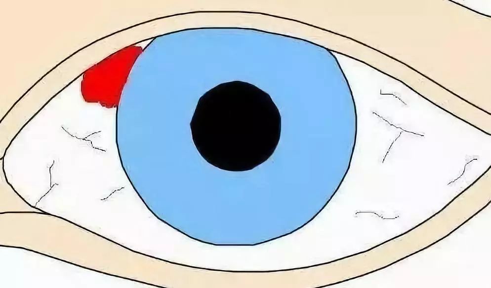 由于球结膜透明,出血后眼白部分可明显看到一片鲜红色.