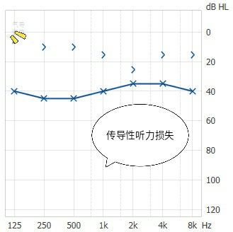 听力的下降,往往是气导下降,骨传导正常,形成传导性听力损失;如图:听