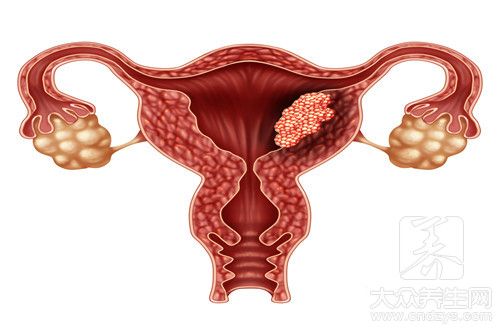 宫颈癌晚期图片 症状图片