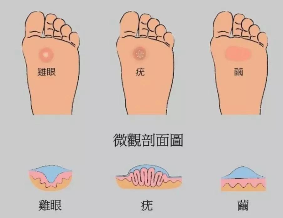 6种常见问题趾甲的形成原因