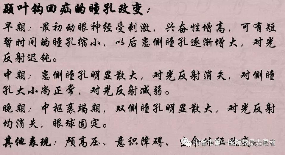 4,原發視神經損傷:患側瞳孔相對擴大,直接光反射消失,間接光反射存在