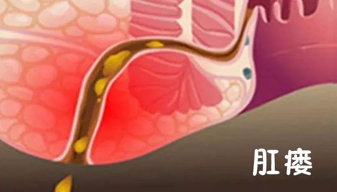 痔疮和肛瘘一定要分清别以为肛门上的就是痔疮