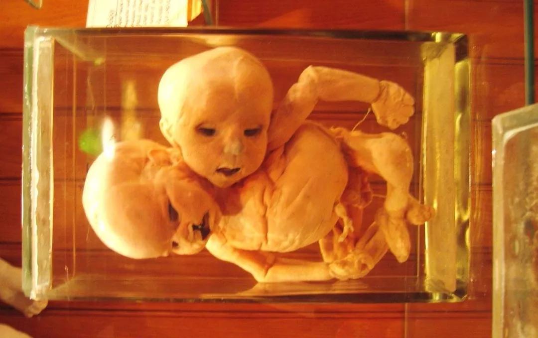 婴儿标本女婴图片