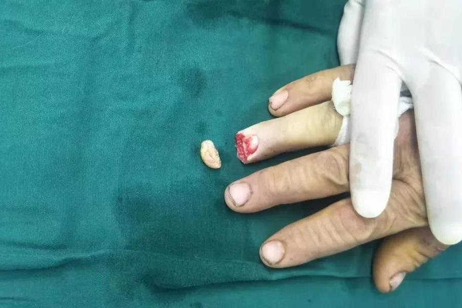 【杭州城东医院案例·手足外科】47岁农民工手指末节完全离断