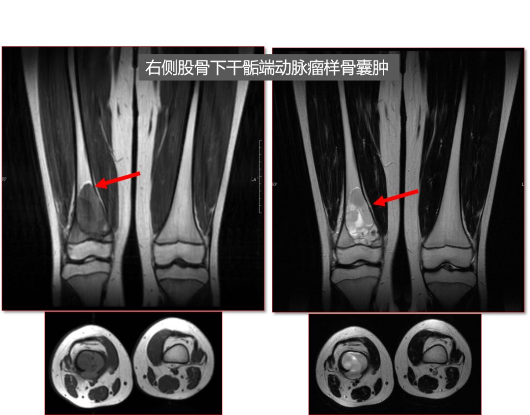 演讲|沈靖南:莫名腿疼,警惕骨肿瘤—医生谈血的教训和肺腑之言